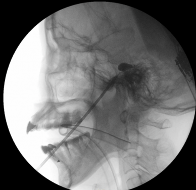 PBC is an interventional technique that alleviates pain by inserting a small balloon into the trigeminal ganglion near the base of the skull and inflating it to compress the nerve’s pain fibres.